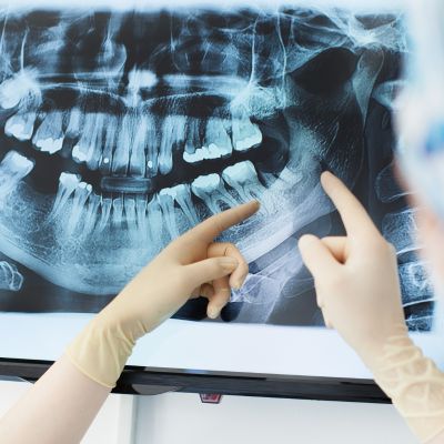 Digital X-Rays in North York