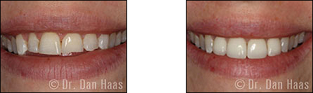 dental veneers - chipped teeth - wilson heights and sheppard toronto