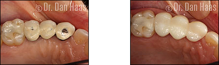 Before and after dental bridge replacement with full porcelain bridge - North York