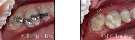 Tooth-colored fillings replacing silver fillings with cavities - North York case