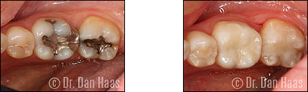 White fillings and resin onlay for decayed teeth - Haas Dental North York
