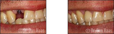 Implant crown and porcelain veneers for front teeth - smile transformation North York