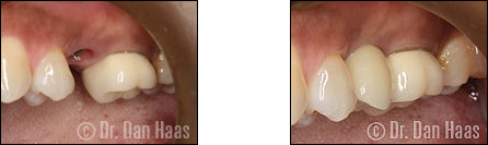 Smile makeover with implant to replace missing tooth - case 4 North York