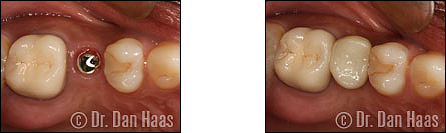 Implant and crown for missing tooth - improved chewing and aesthetics