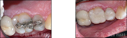 Resin onlays replacing failing silver fillings - North York case 1