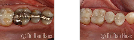 Onlays and inlays to replace old amalgam fillings with cracks - Haas Dental North York