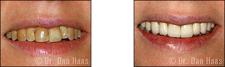 Porcelain veneers and crowns transformation - case 1, Haas Dental North York