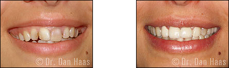 Implant crown and porcelain veneers - smile makeover case 2 in North York