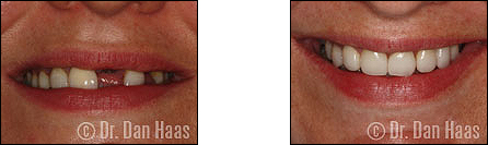 Front teeth restoration with crowns and veneers - North York case 3