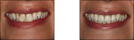 Porcelain veneers to fix chipping, crowding and discoloration - North York