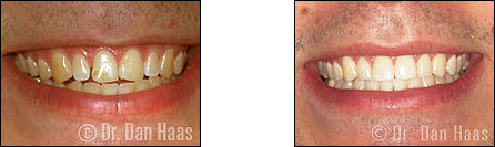 Dental veneers for tooth shape and spacing issues - cosmetic dentistry North York
