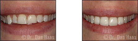 Veneers for chipped and square-shaped teeth - North York smile gallery